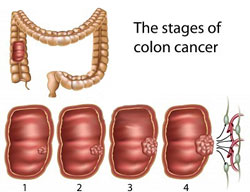 colon-cancer