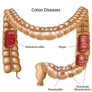 colon-diseases